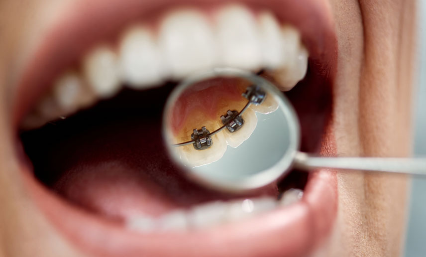 Are There Braces That Go Behind Your Teeth?